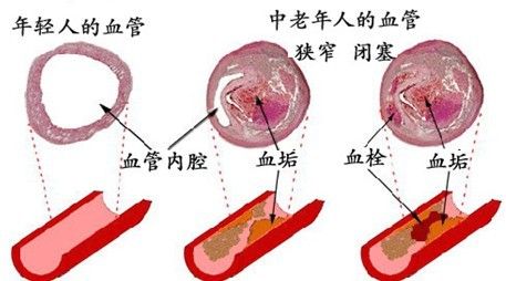是什么原因導致血管壽命減少-陜西千秋玄鹿治療儀