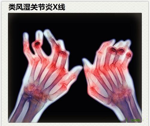 類風(fēng)濕性關(guān)節(jié)炎真的是“不死的癌癥”？