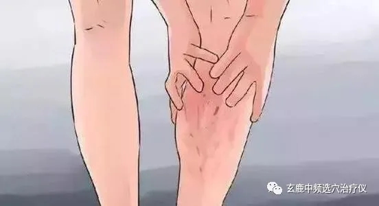 治療靜脈曲張，中醫(yī)有良方，一根針讓你告別“蚯蚓”腿
